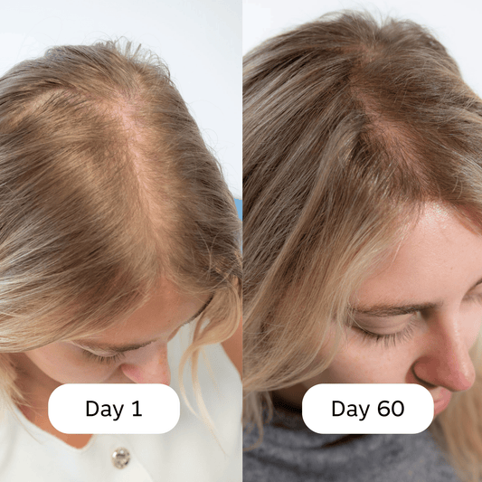 Before and after comparison of hair growth over 60 days on a person.